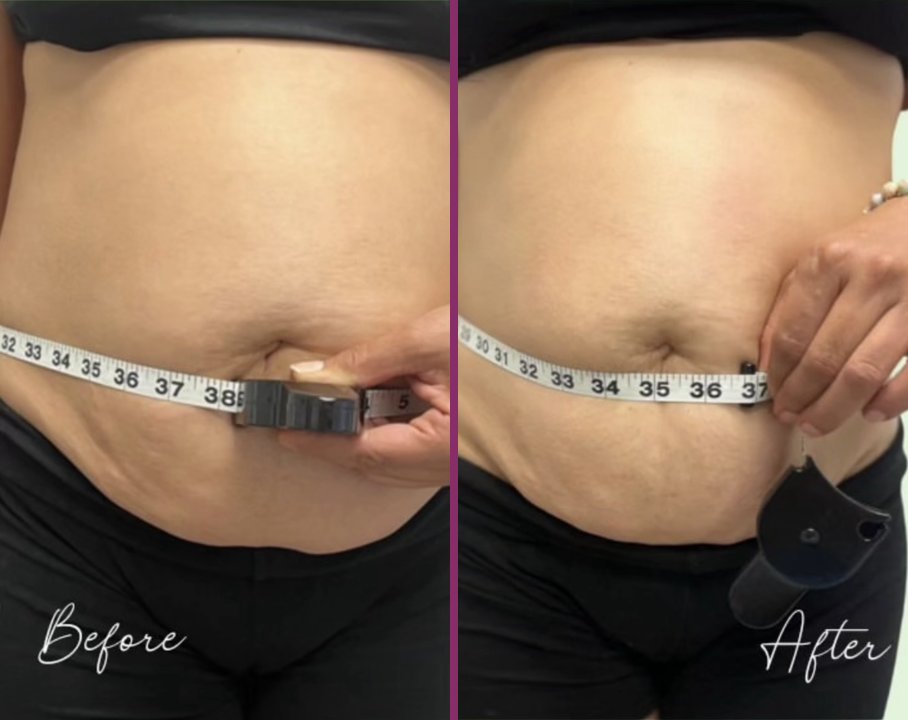 A client's waist measured with a tape before and after cavitation, with a smaller measurement after