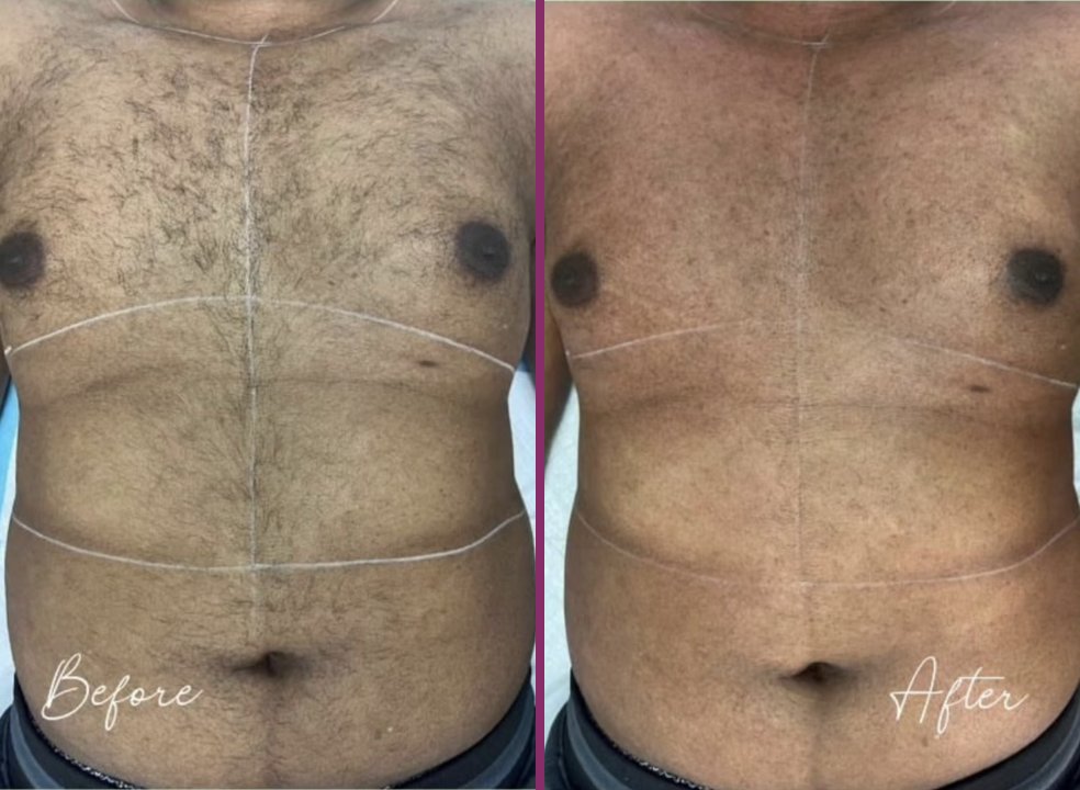 A man's chest and stomach before and after laser hair removal