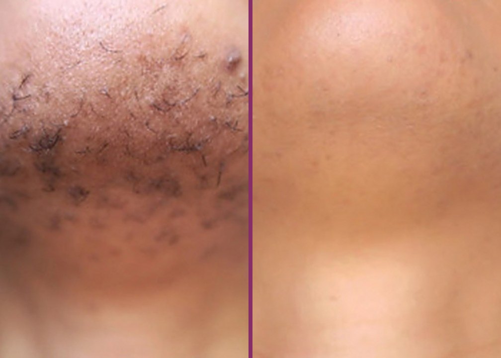 A chin with coarse dark hairs before laser, and smooth skin after