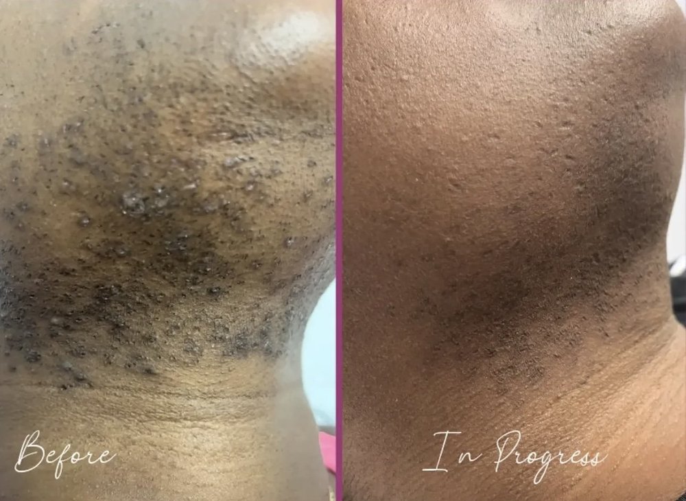 A woman's chin and neck covered in hair bumps before, and much clearer partway through laser