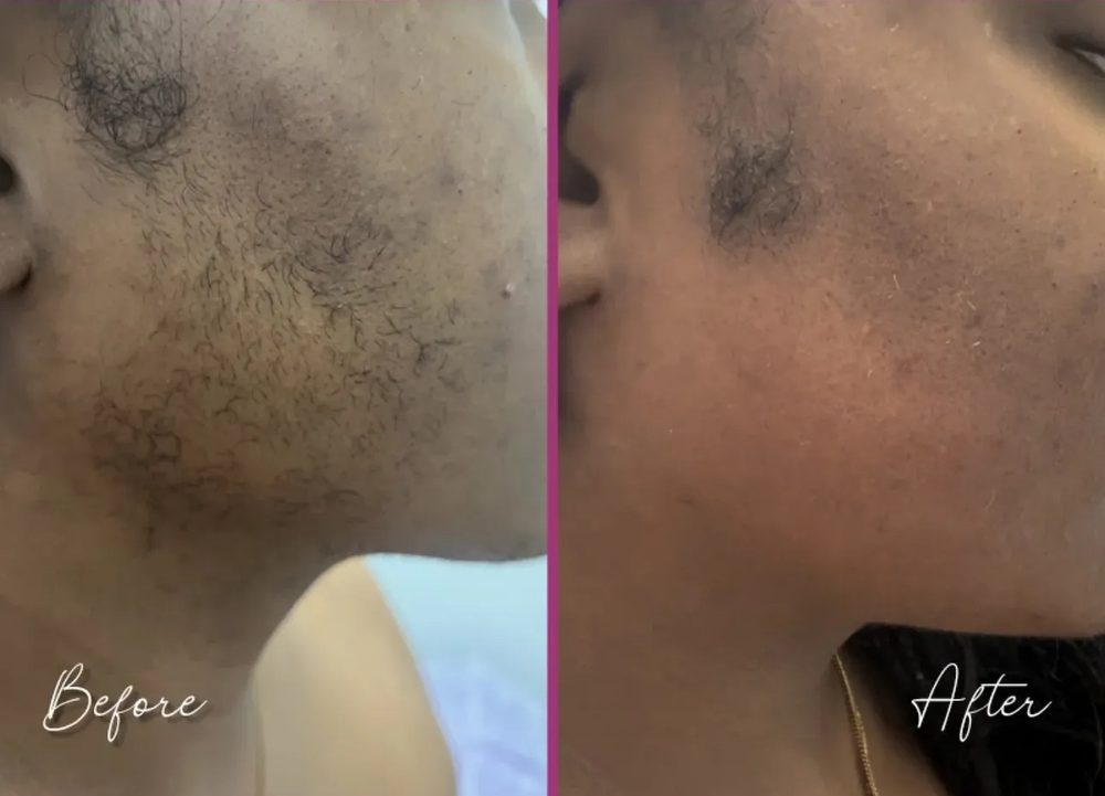 Before and after laser hair removal on a woman's chin and jaw