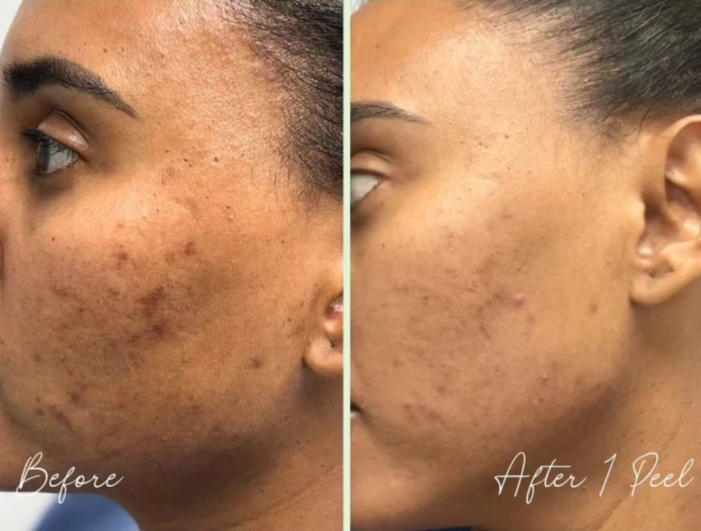 A client's cheek with dark spots before, and clearer, more even skin after one Coral Peel