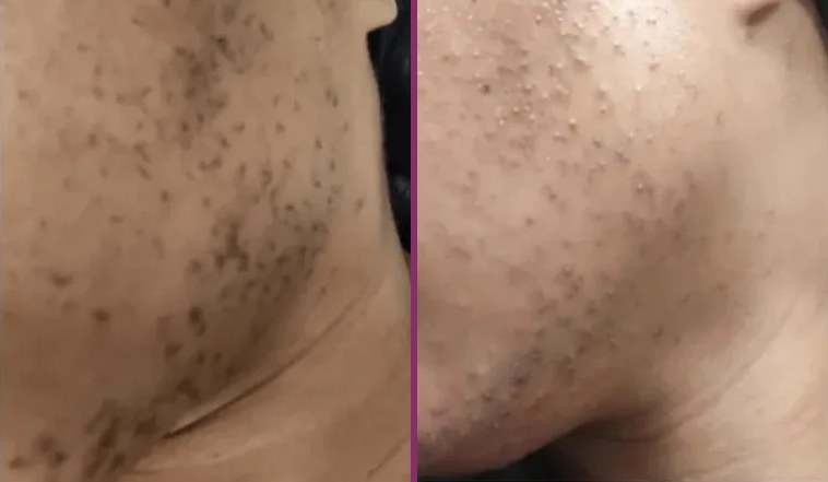 A client's jaw with many dark hairs before electrolysis, and far fewer after
