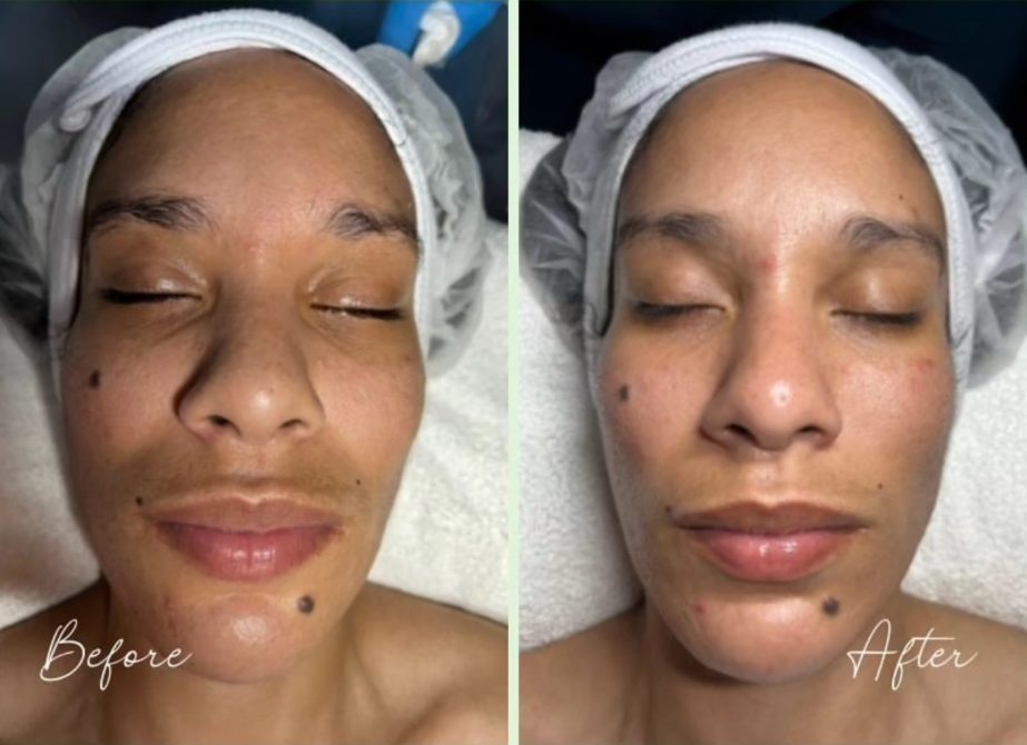 A client's face before and after a Hydro Facial