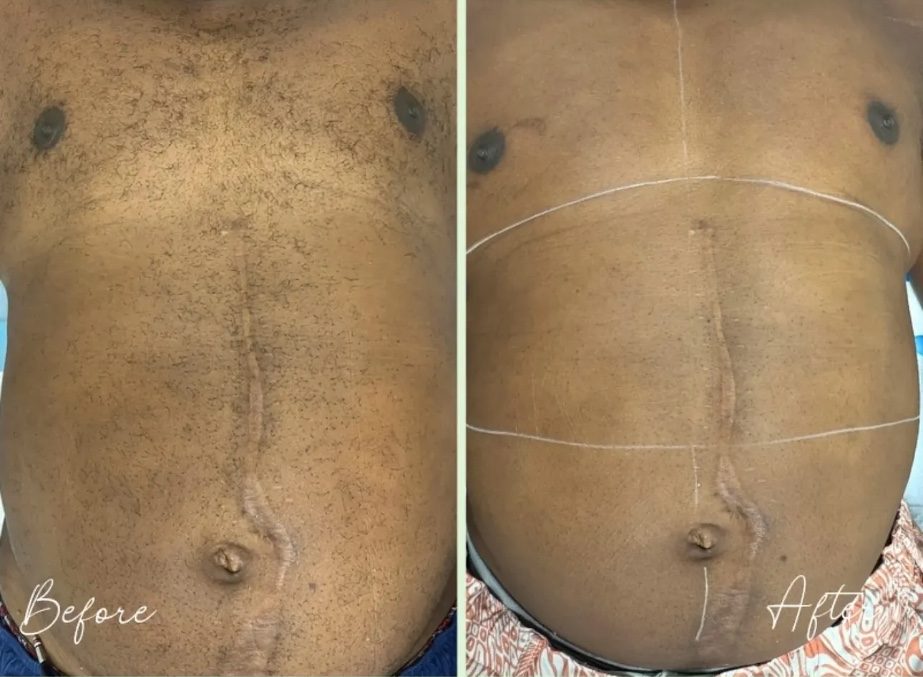 Before and after laser hair removal on a man's stomach